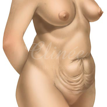 abdominoplastia-indicacao (1)